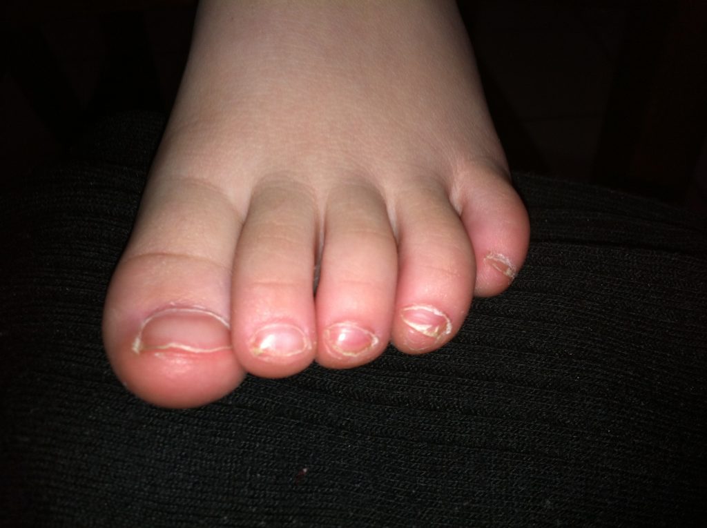 Childrens Podiatry curly toes