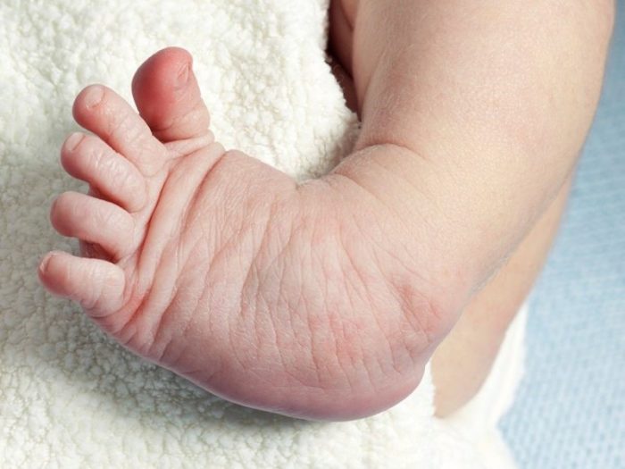 Childrens Podiatry What is Clubfoot?