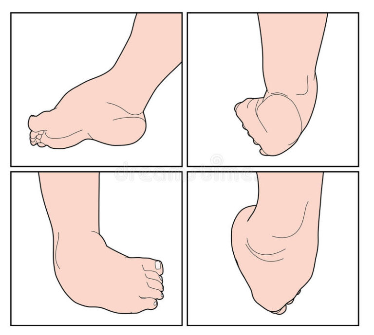 Childrens Podiatry What Is Clubfoot childrens-podiatry-what-is-clubfoot