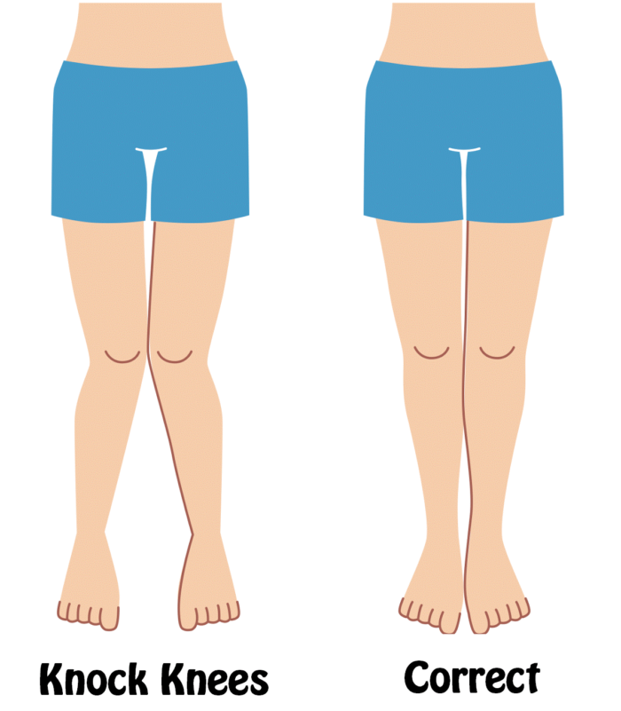 Childrens Podiatry Does Your Child Have Knock Knees?