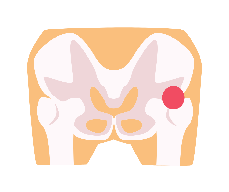 Hip Dysplasia in Children what you need to know! Children Podiatry